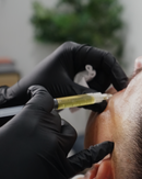 PRP Microneedling + PRP Injections Under Eye and Smile Lines