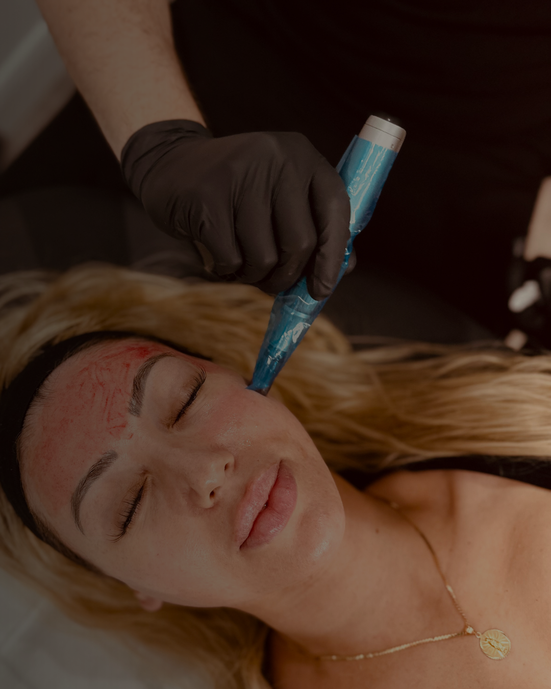 Radiance Reset – Glow Trio Treatment package (Tox, Micro-needling, Lips)