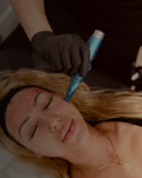 Radiance Reset – Glow Trio Treatment package (Tox, Micro-needling, Lips)
