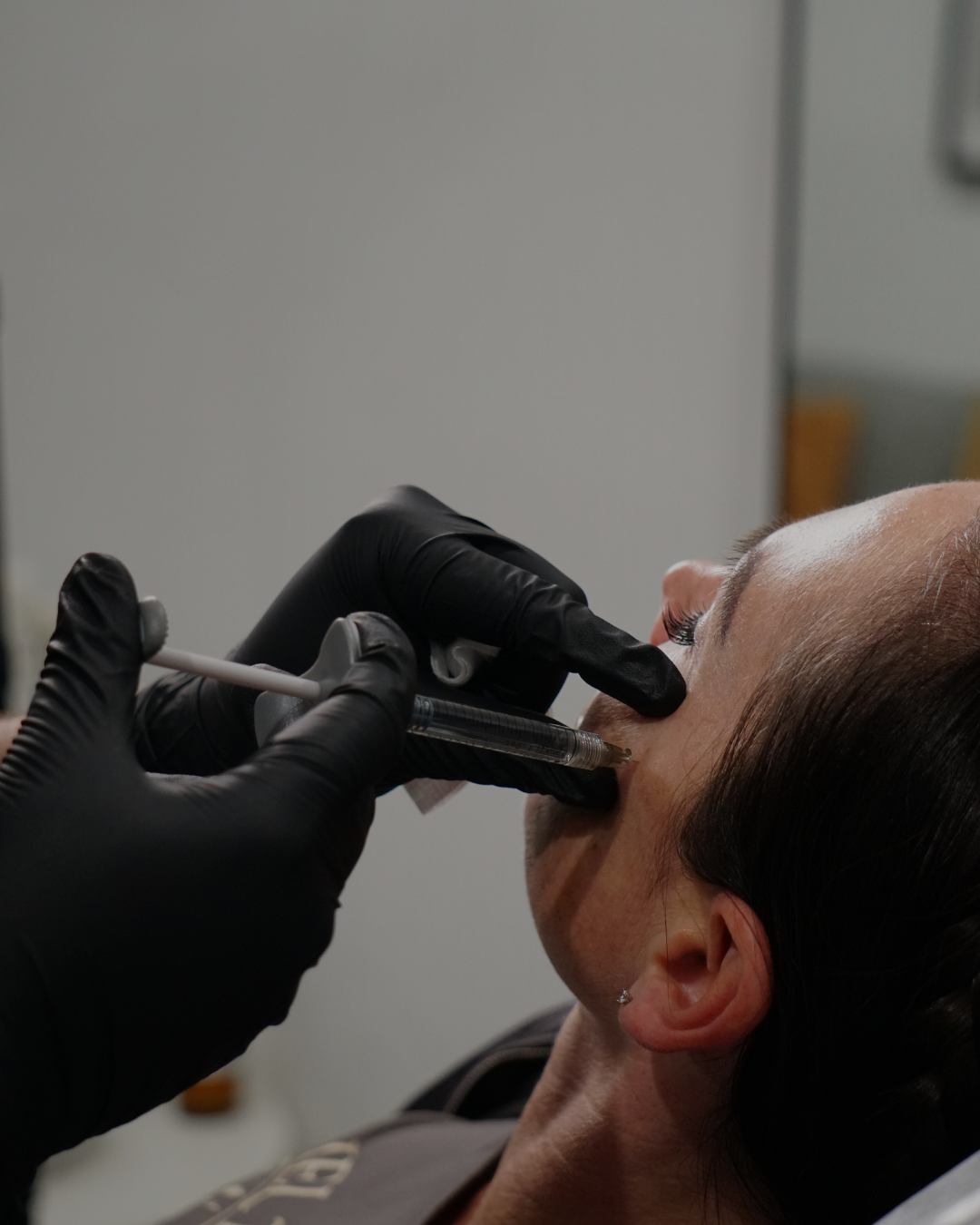 Radiance Reset (60 units of Botox + 3 syringes)