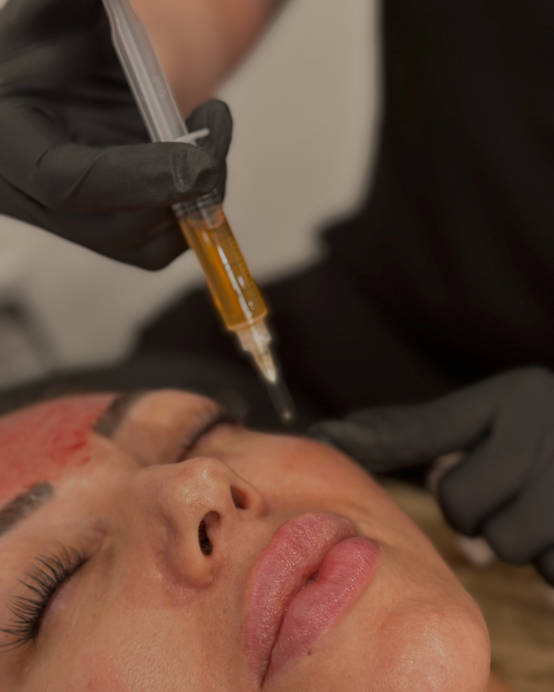 Radiance Reset – 60 Units Tox + PRP Micro-needling and Injections
