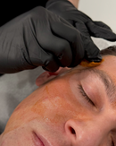 VI Chemical Peel